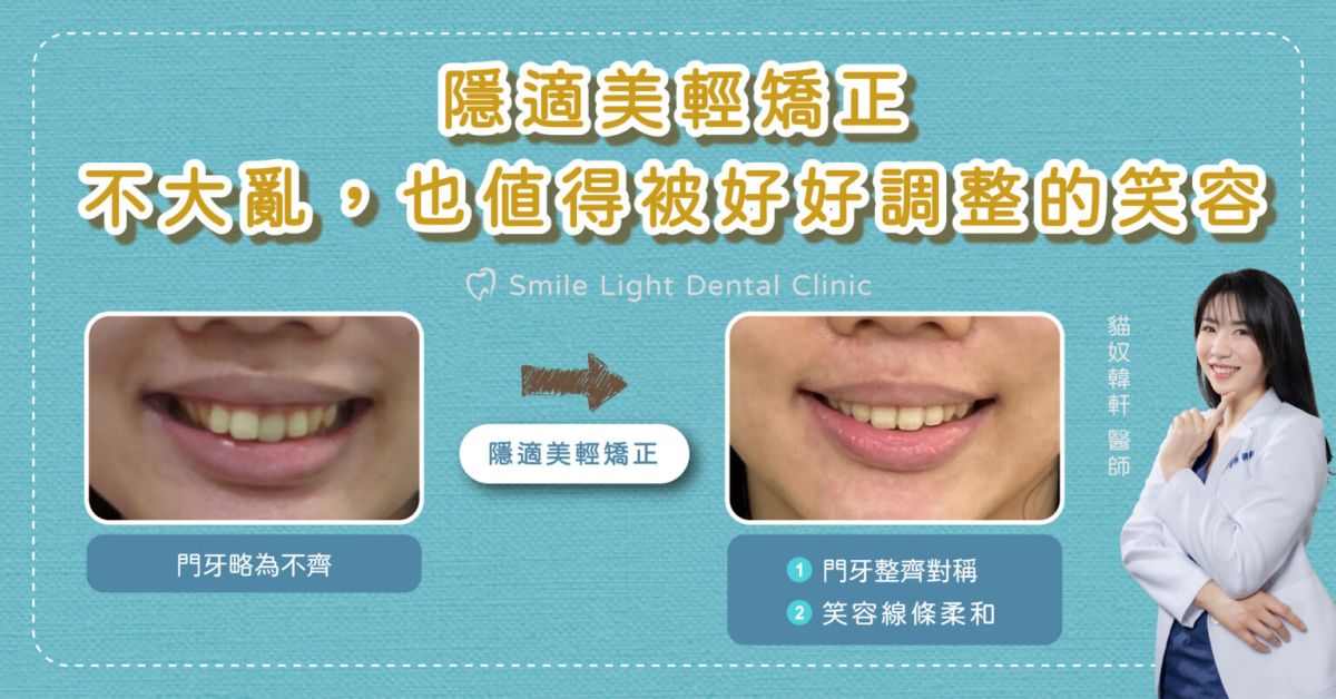 想要改善臉型？城上城推薦欣隆牙醫、欣城牙醫的隱適美隱形矯正。我們提供詳細的矯正價格分析與 2026 最新案例分享，讓您在長庚商圈就能享受舒適且美觀的牙齒矯正體驗。